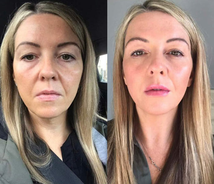 Before and after images of a patient who's had a skin booster treatment
