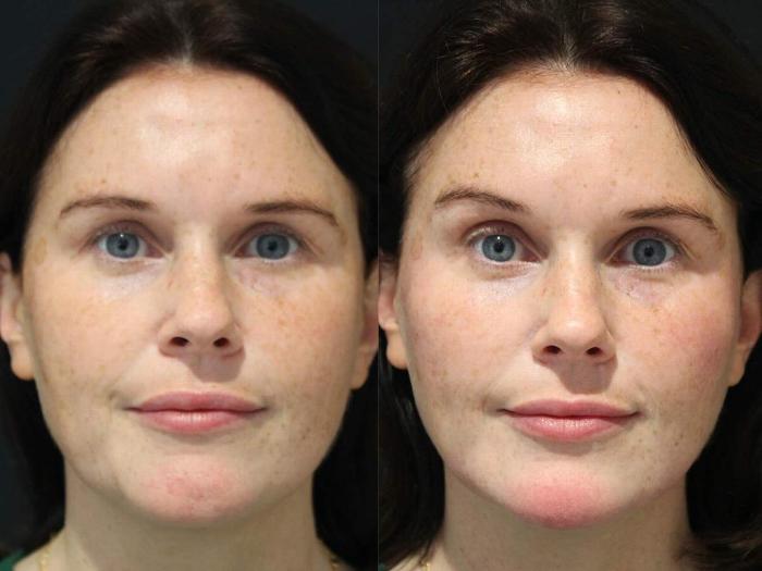Before and after Radiesse treatment