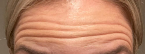 Wrinkles on a forehead before an anti-wrinkle treatment
