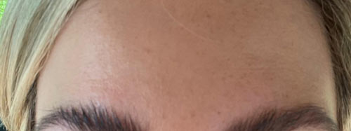 A smooth forehead after an anti wrinkle treatment