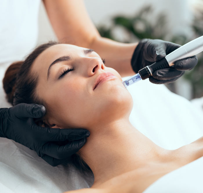 A woman getting a microneedling treatment