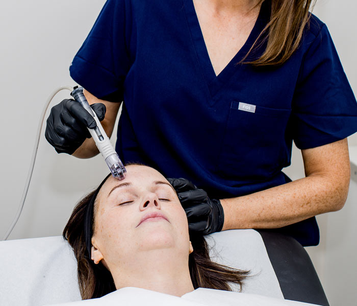 A woman getting a DermaFrac treatment
