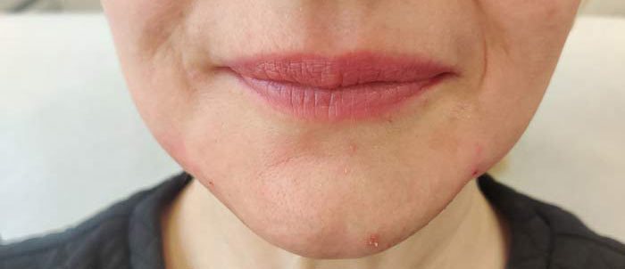 a chin after dermal fillers
