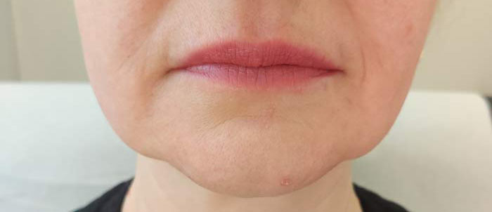 A chin before dermal fillers