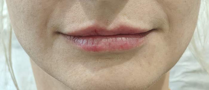 Lips after lip fillers