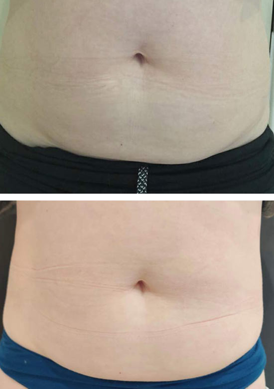 A stomach before and After Aqualyx treatment