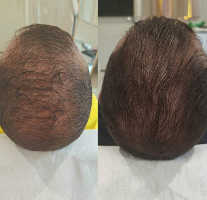 Before and after PRP therapy for hair restoration