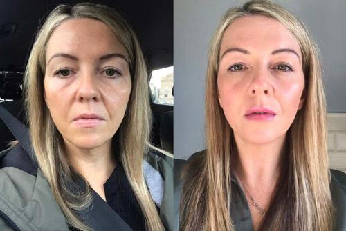 Before and after a skin booster treatment